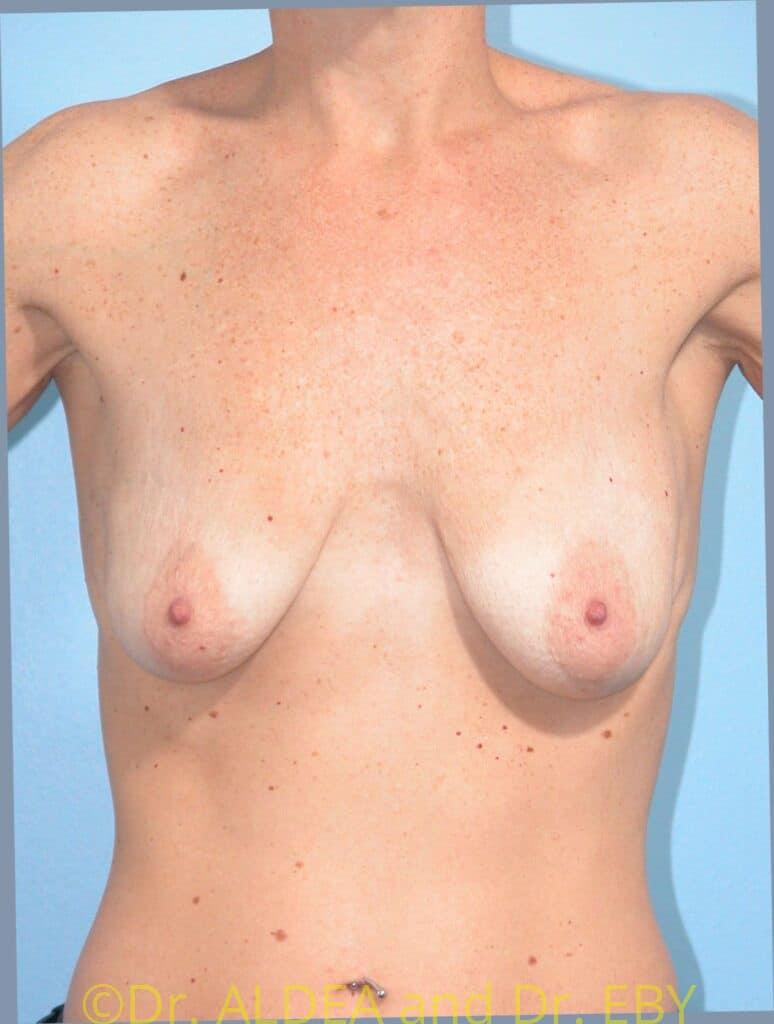 Before Image: Breast Augmentation w/ Lift #843 - front