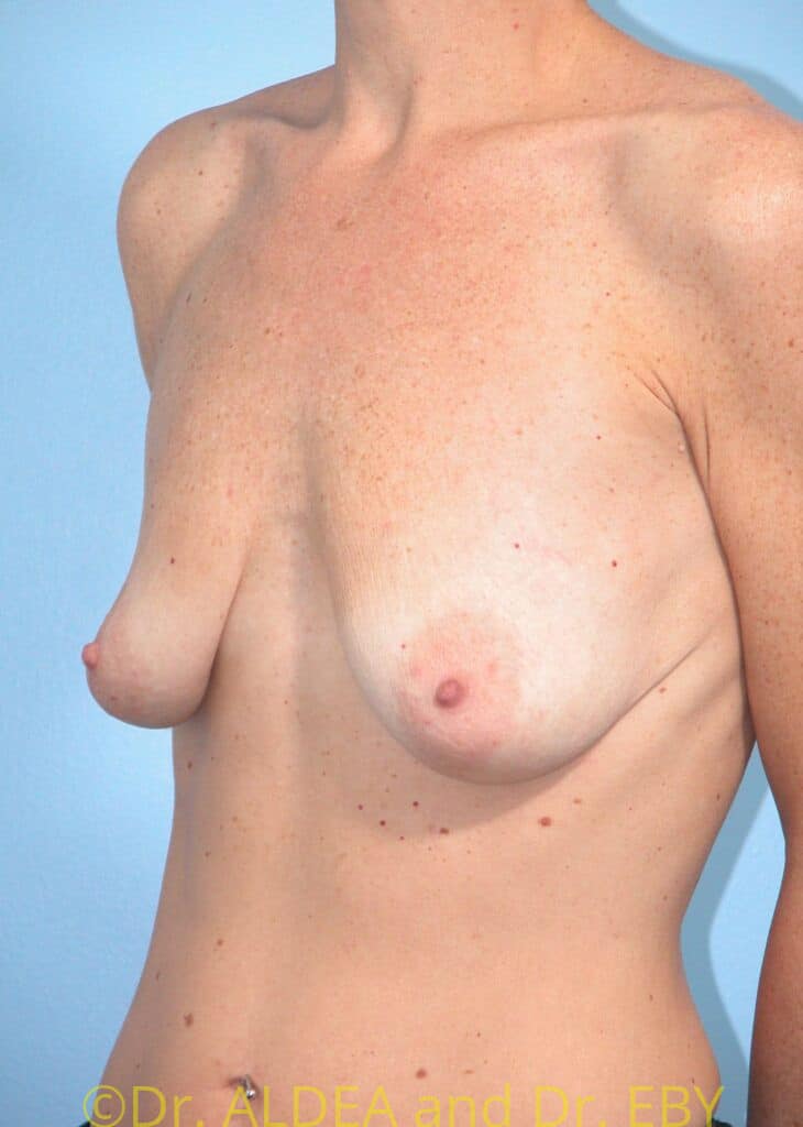 Before Image: Breast Augmentation w/ Lift #843 - left-front-oblique