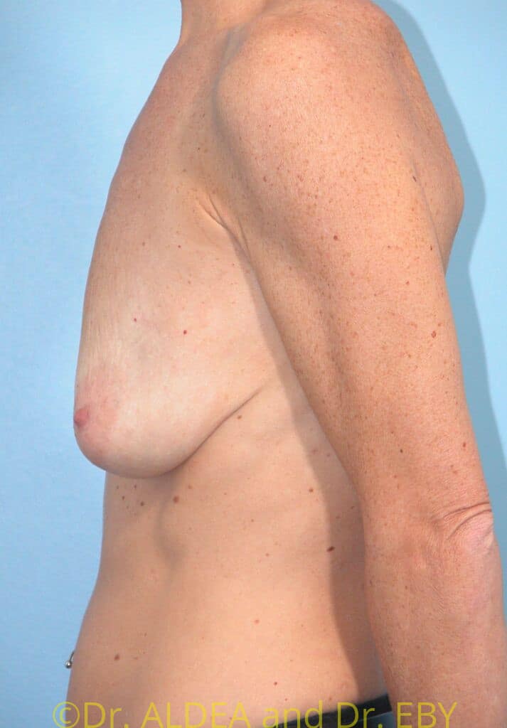 Before Image: Breast Augmentation w/ Lift #843 - left-side