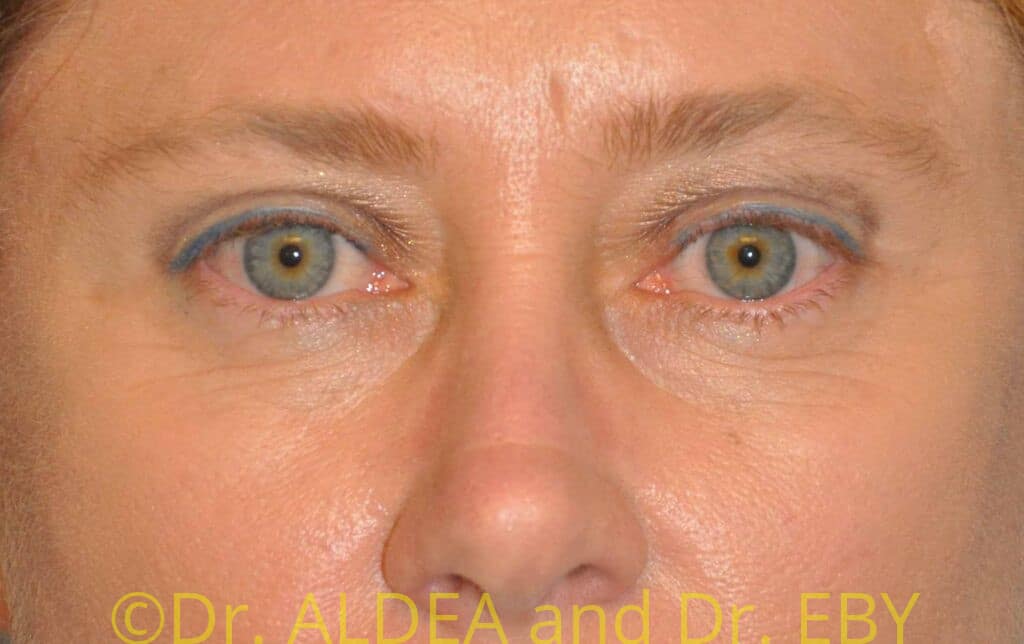 After Image: Blepharoplasty #066 - front