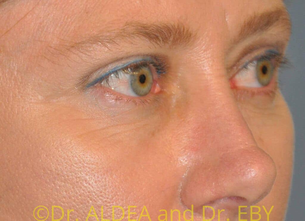 After Image: Blepharoplasty #066 - right-front-oblique