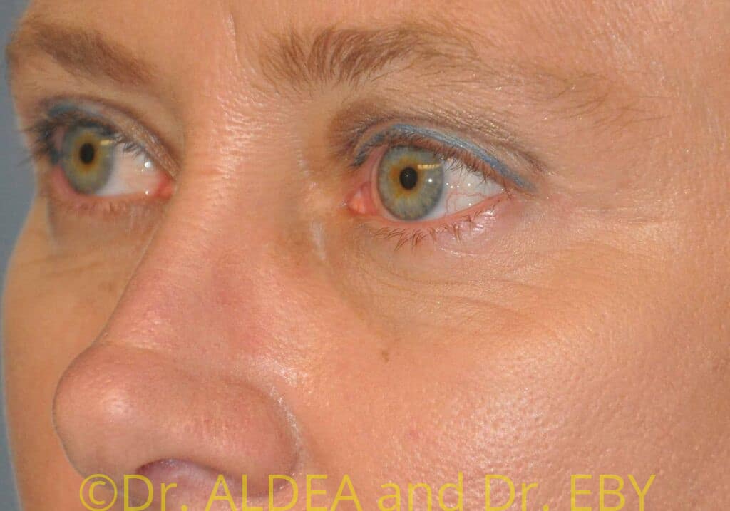 After Image: Blepharoplasty #066 - left-front-oblique