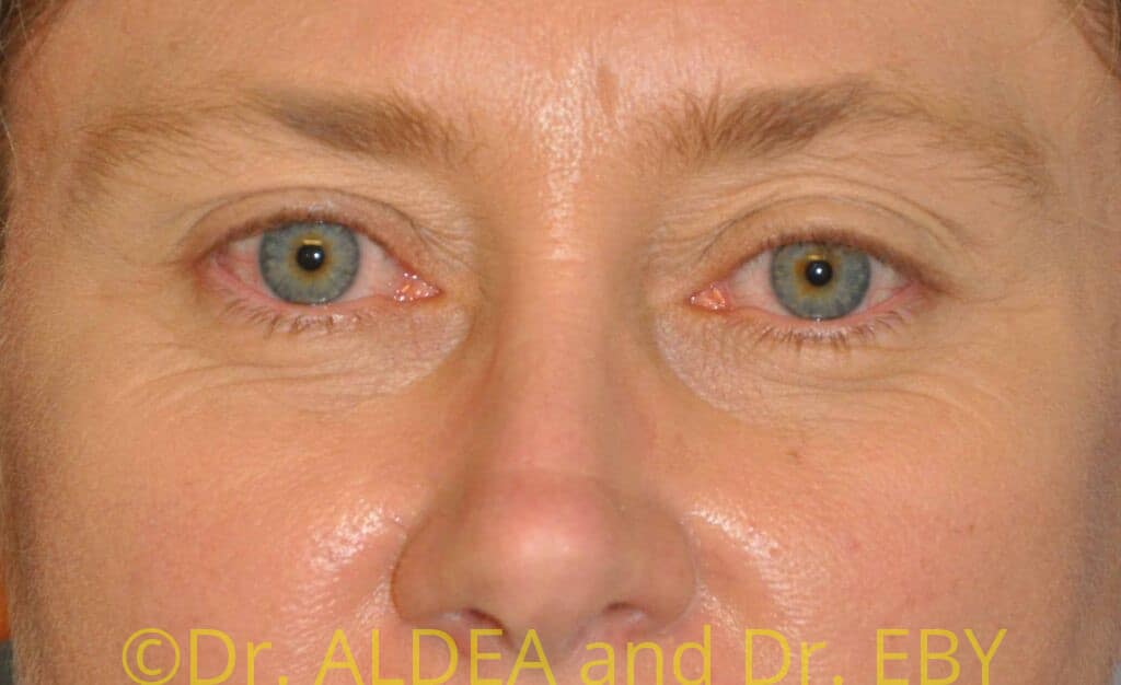 Before Image: Blepharoplasty #066 - front