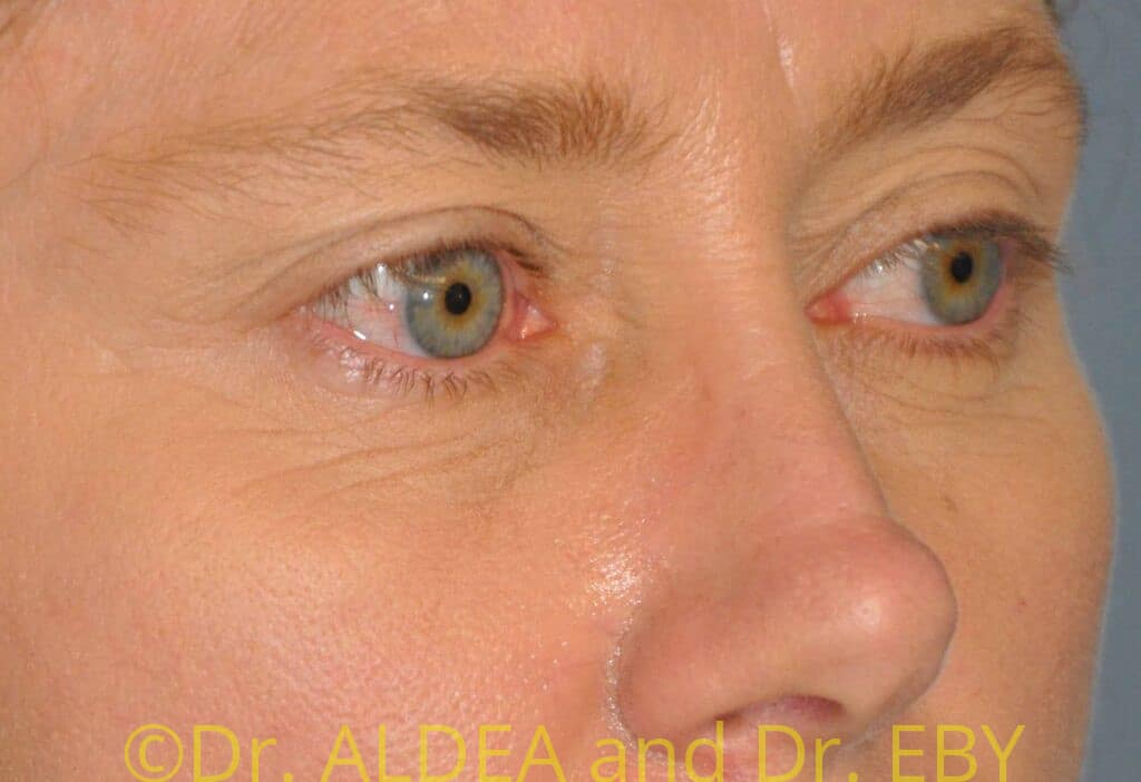 Before Image: Blepharoplasty #066 - right-front-oblique