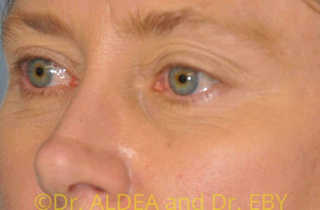 Before Image: Blepharoplasty #066 - left-front-oblique