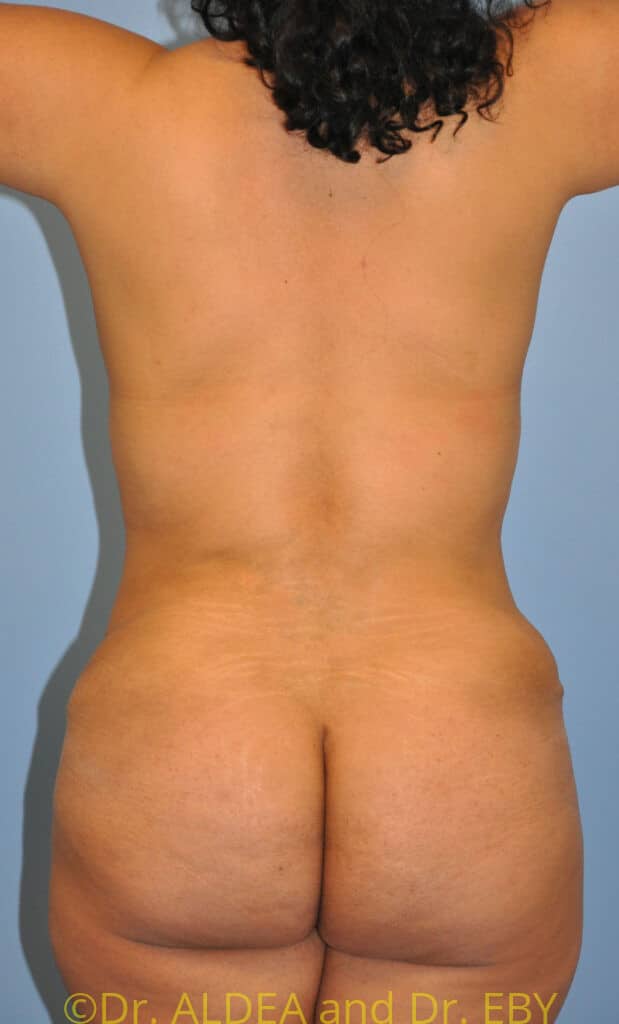 After Image: Back Scoop Liposuction #630 - back