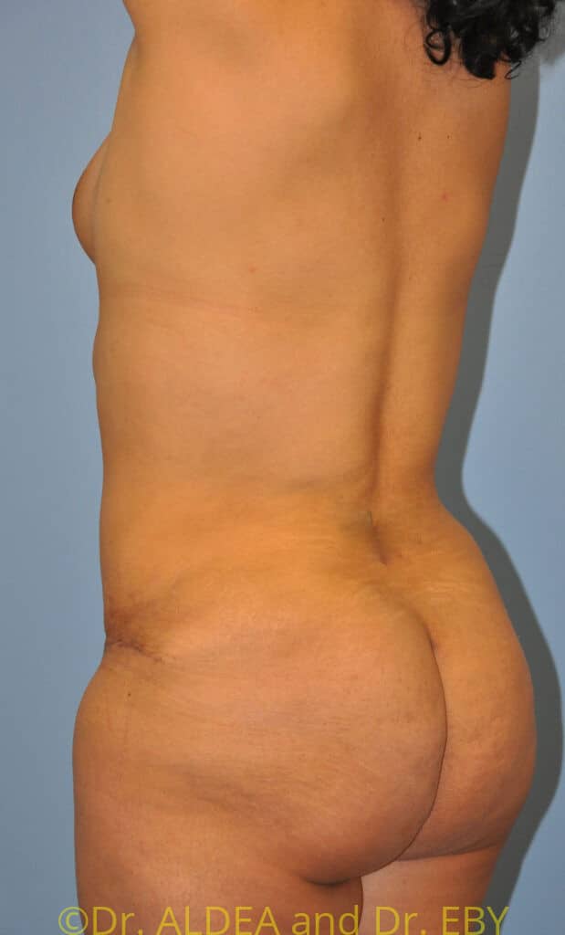 After Image: Back Scoop Liposuction #630 - left-back-oblique