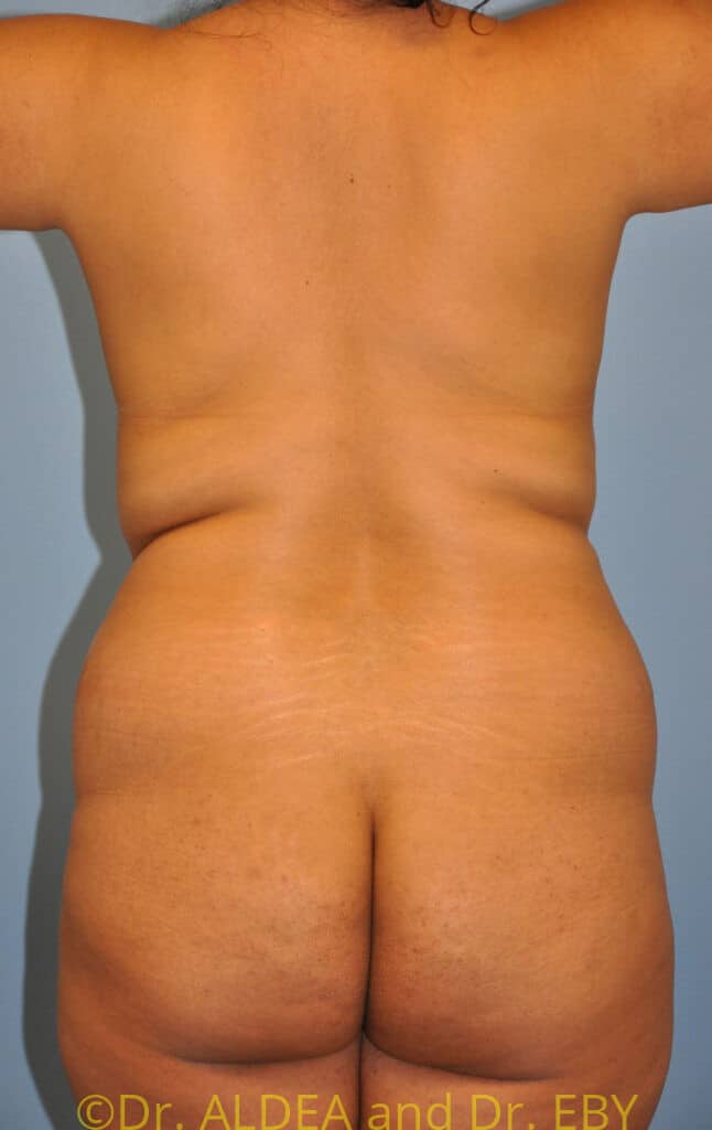 Before Image: Back Scoop Liposuction #630 - back