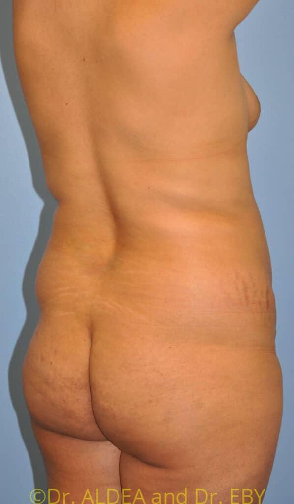 Before Image: Back Scoop Liposuction #630 - right-back-oblique