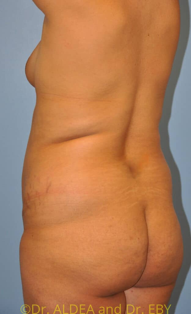 Before Image: Back Scoop Liposuction #630 - left-back-oblique