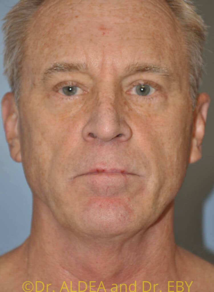 Before Image: Facelift #342 - front
