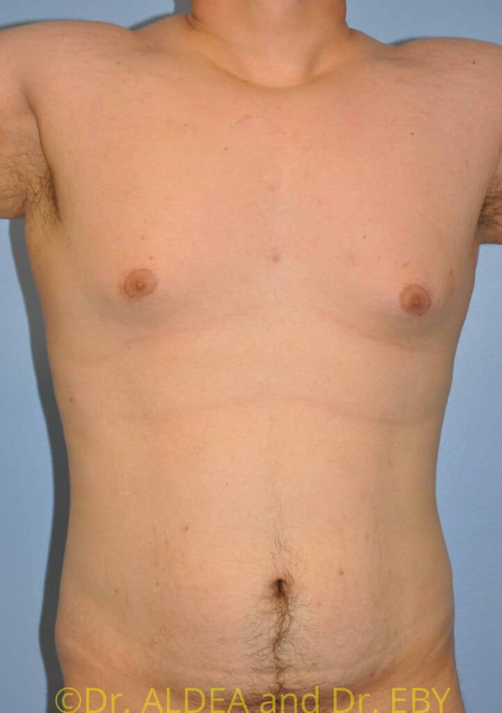 Before Image: Gynecomastia #919 - front