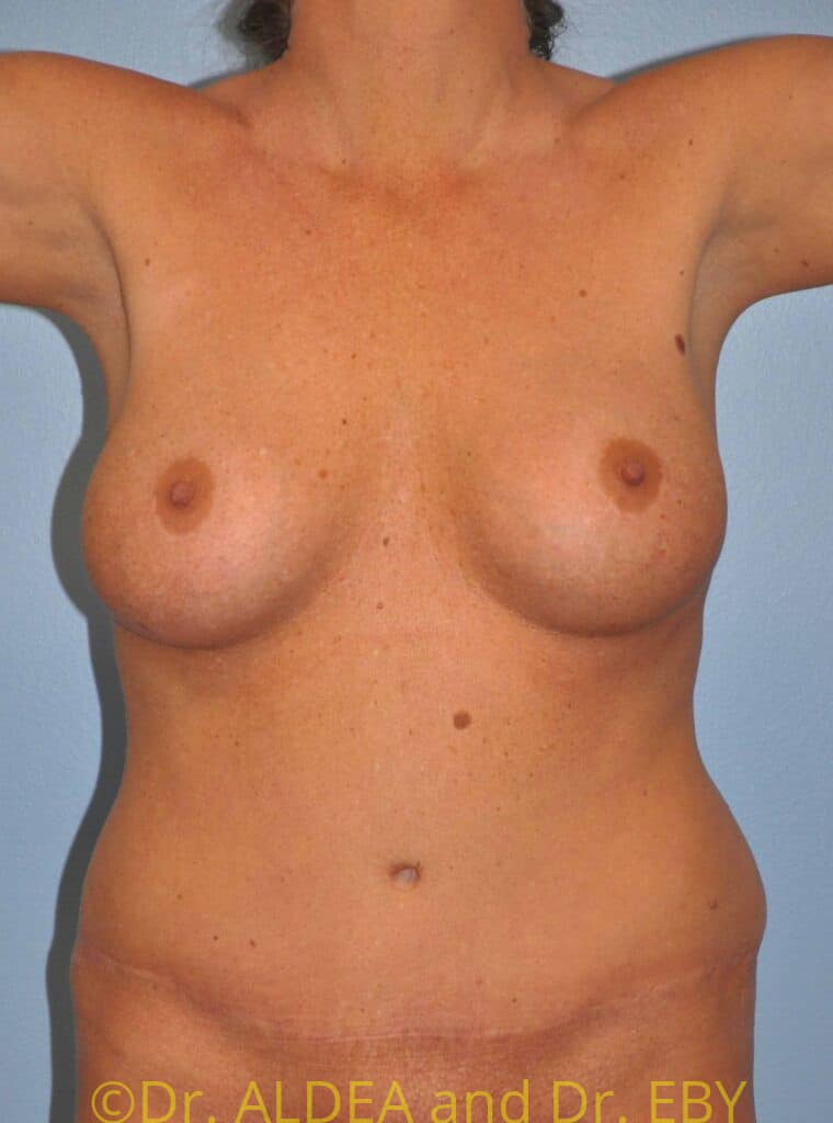 Before Image: Liposuction #930 - front