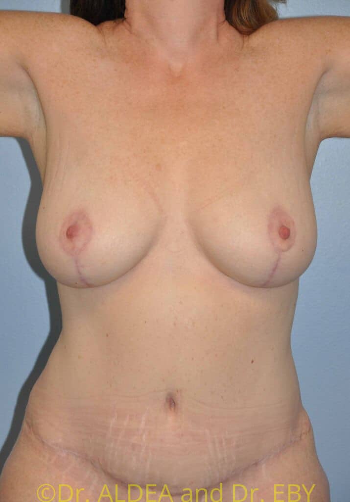After Image: Mommy Makeover #667 - front