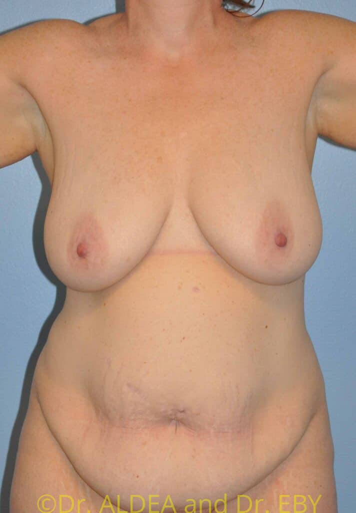 Before Image: Mommy Makeover #667 - front