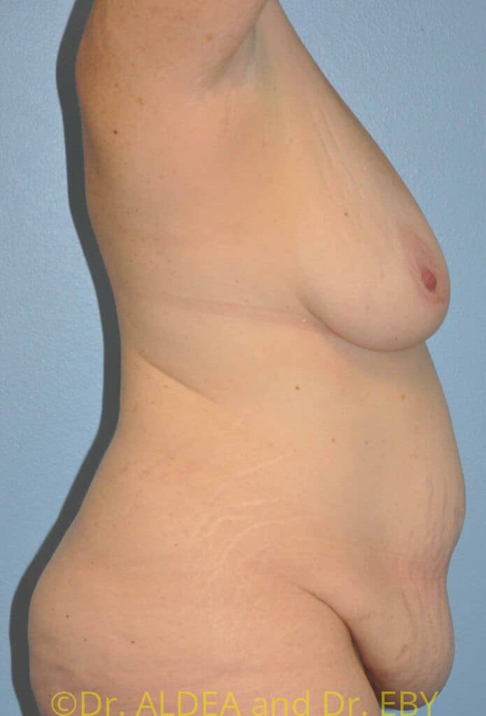 Before Image: Mommy Makeover #667 - right-side