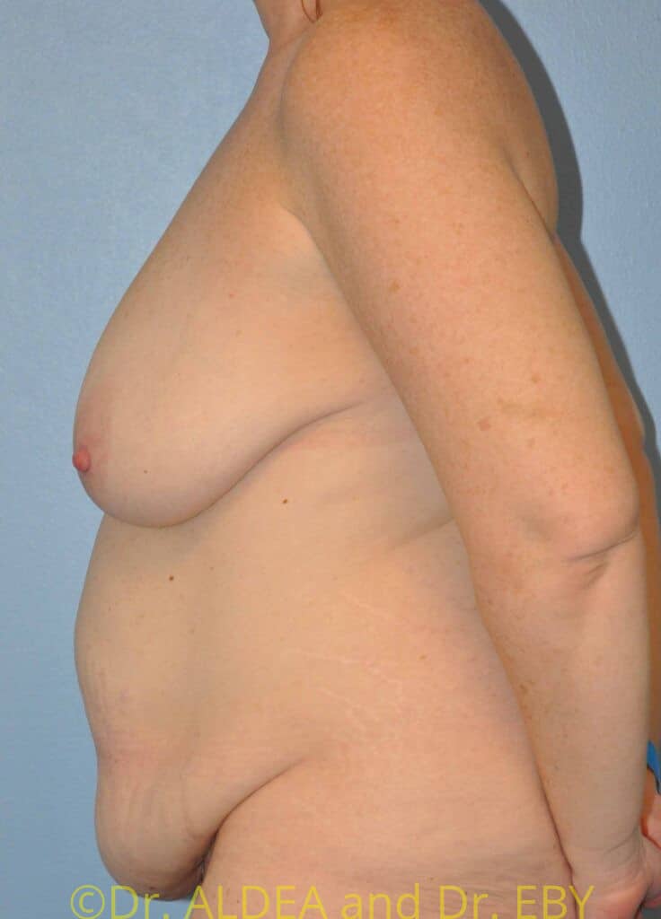 Before Image: Mommy Makeover #667 - left-side