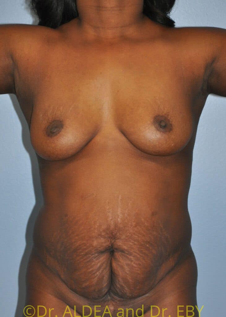 Before Image: Tummy Tuck #610 - front