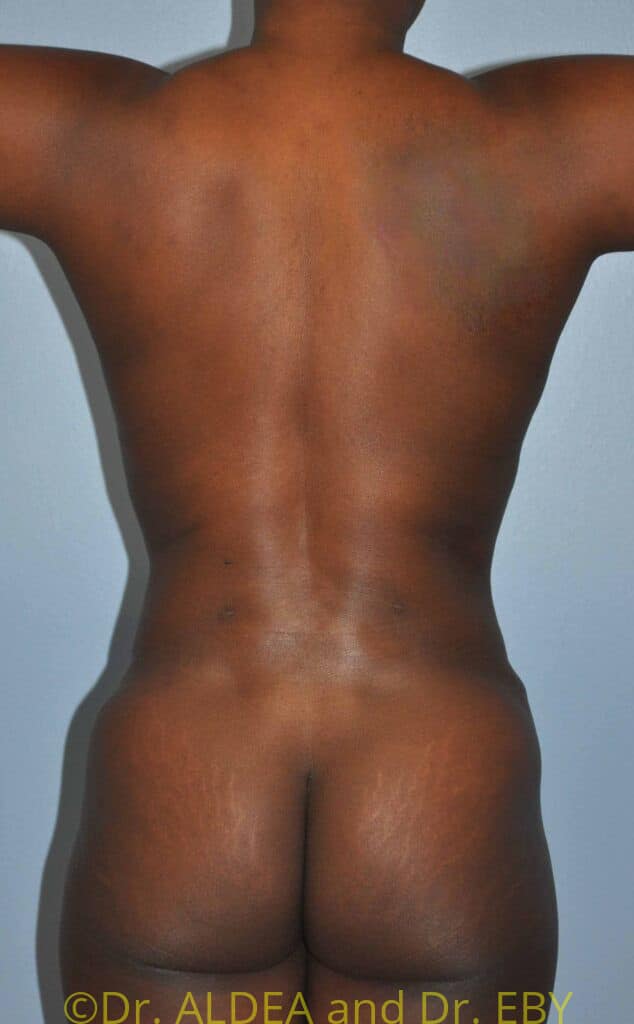 After Image: Tummy Tuck #610 - back