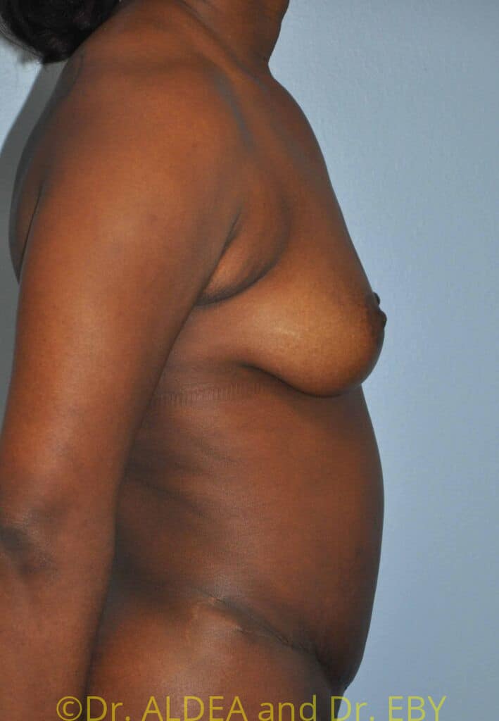 After Image: Tummy Tuck #610 - right-side