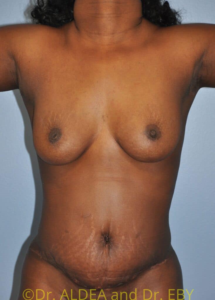 After Image: Tummy Tuck #610 - front