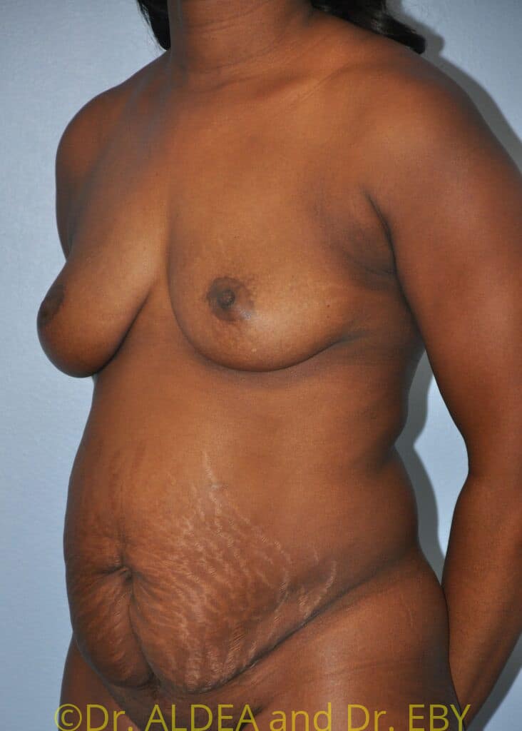 Before Image: Tummy Tuck #610 - left-front-oblique