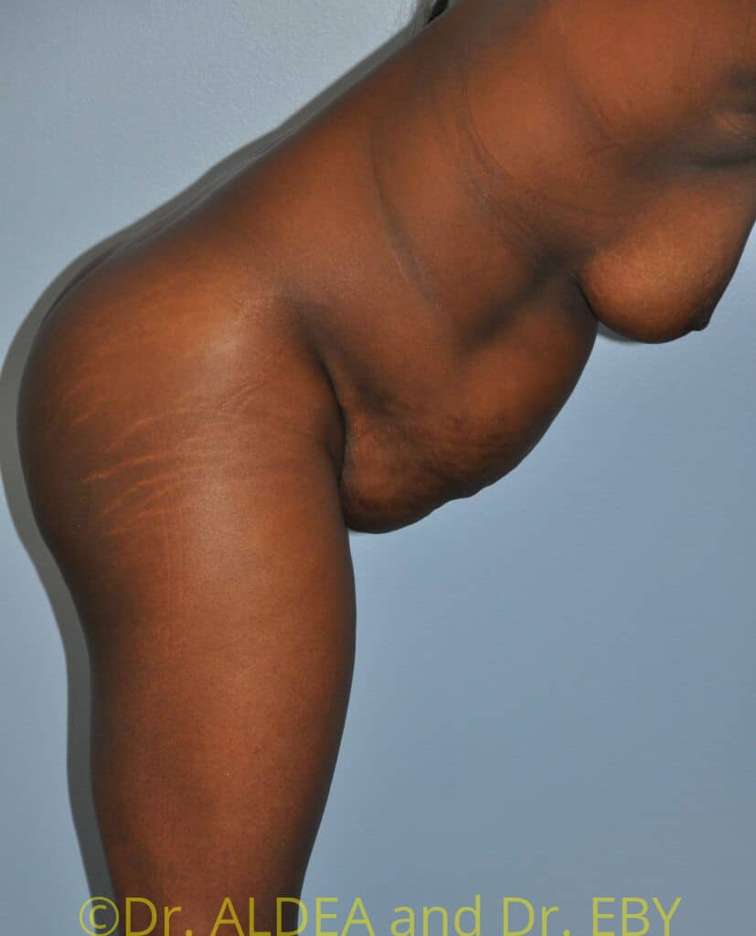Before Image: Tummy Tuck #610 - other