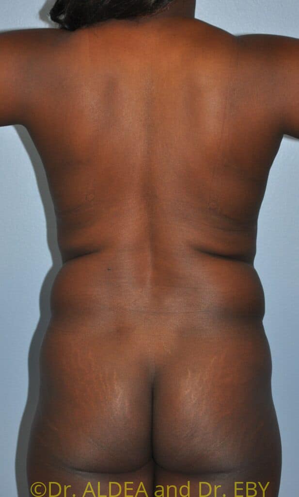 Before Image: Tummy Tuck #610 - back