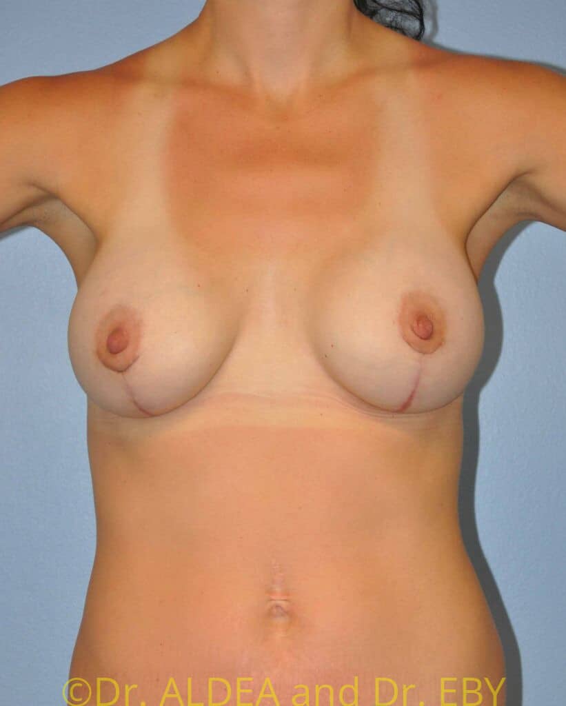 After Image: Breast Augmentation w/ Lift #178 - front