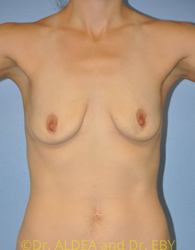 Before Image: Breast Augmentation w/ Lift #178 - front