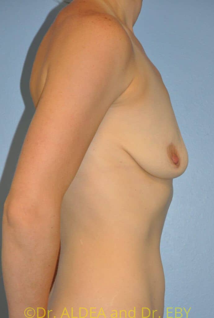 Before Image: Breast Augmentation w/ Lift #178 - right-side