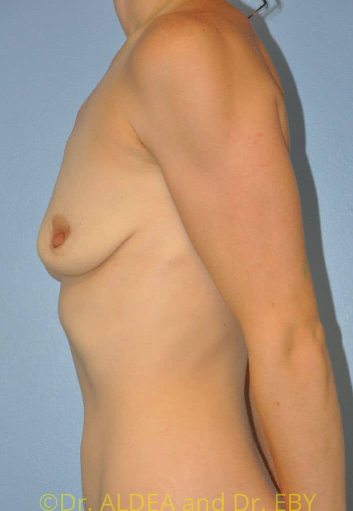 Before Image: Breast Augmentation w/ Lift #178 - left-side