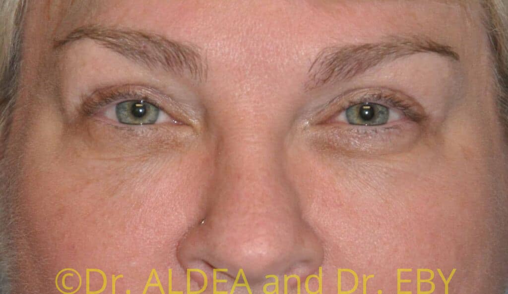 After Image: Blepharoplasty #355 - front