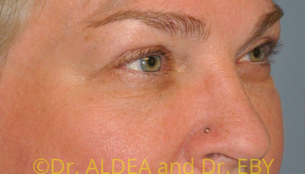 After Image: Blepharoplasty #355 - right-front-oblique