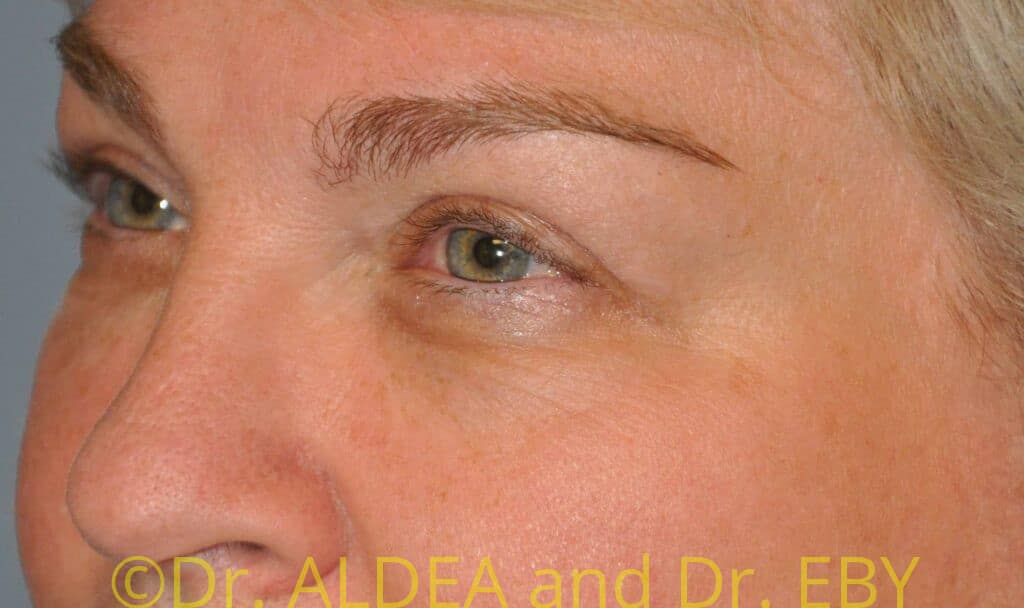 After Image: Blepharoplasty #355 - left-front-oblique
