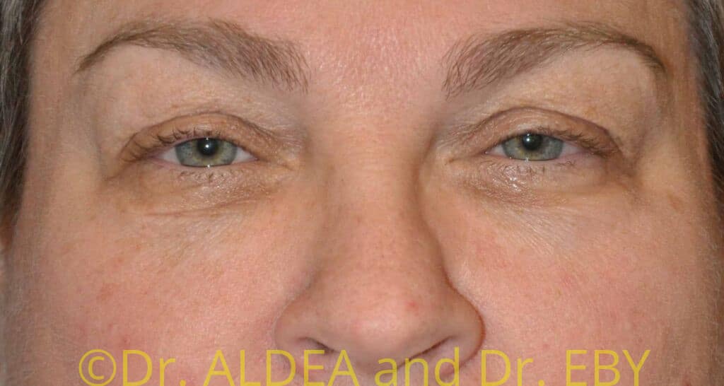 Before Image: Blepharoplasty #355 - front