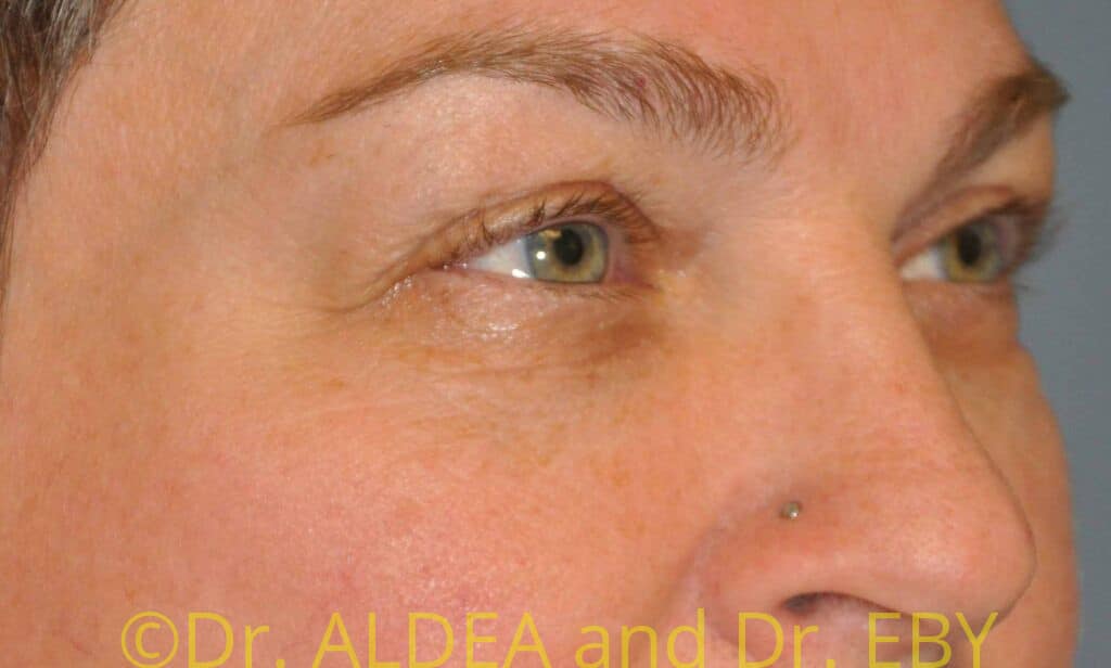Before Image: Blepharoplasty #355 - right-front-oblique