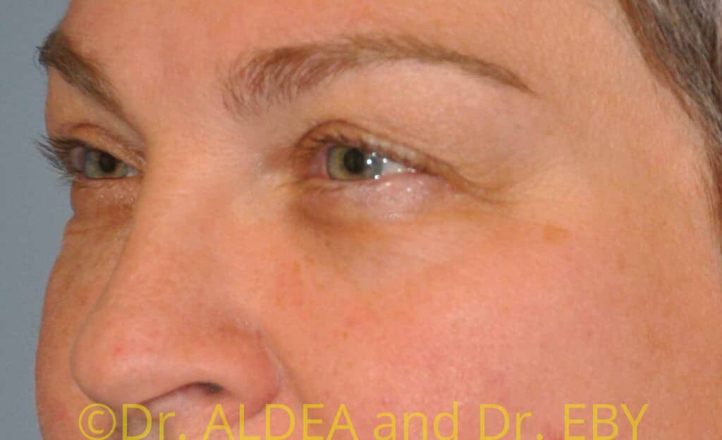 Before Image: Blepharoplasty #355 - left-front-oblique