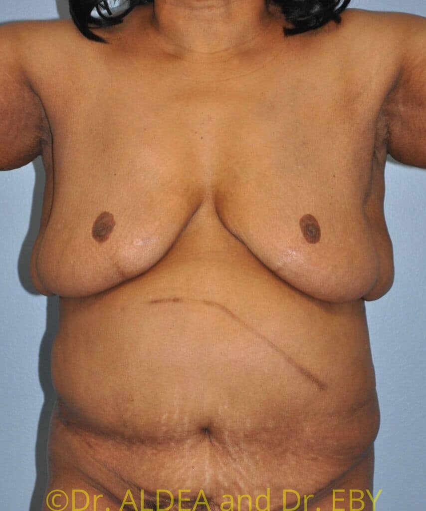 Before Image: Liposuction #297 - front