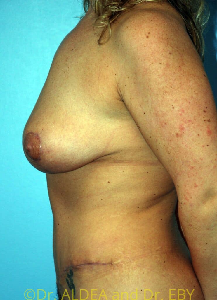 After Image: Mommy Makeover #859 - left-side