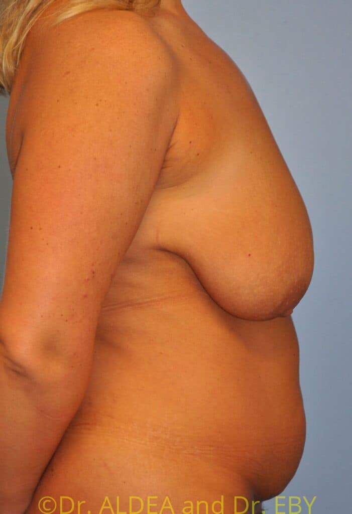 Before Image: Mommy Makeover #859 - right-side