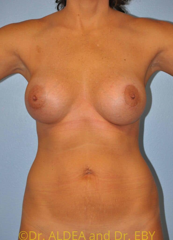 After Image: Breast Augmentation w/ Lift #210 - front