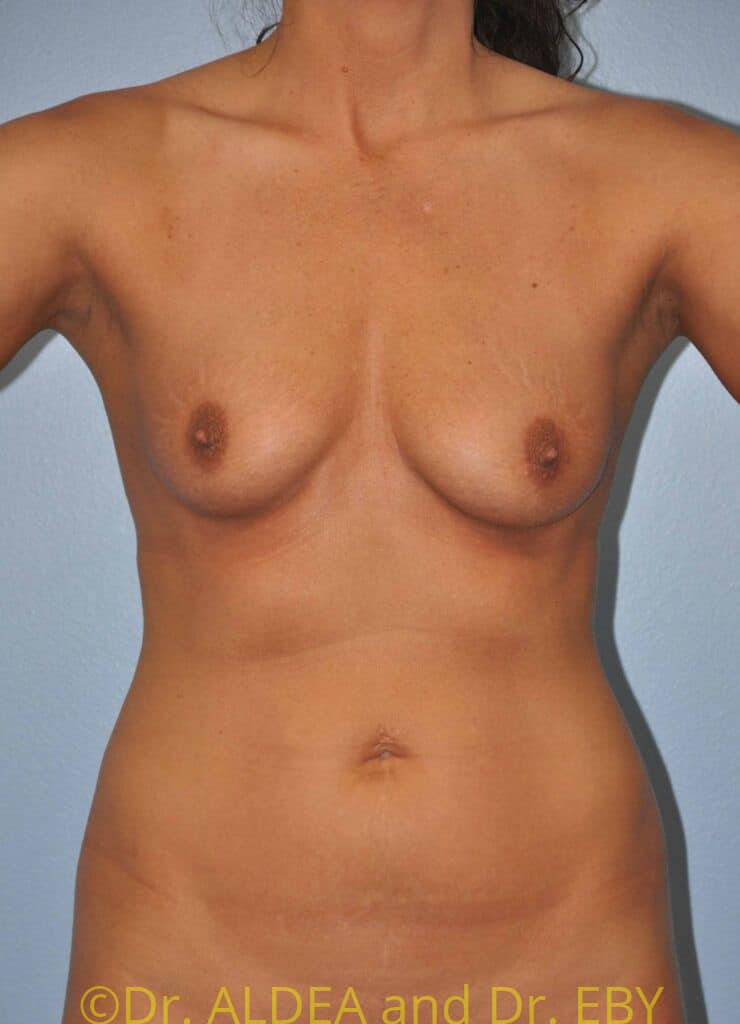 Before Image: Breast Augmentation w/ Lift #210 - front