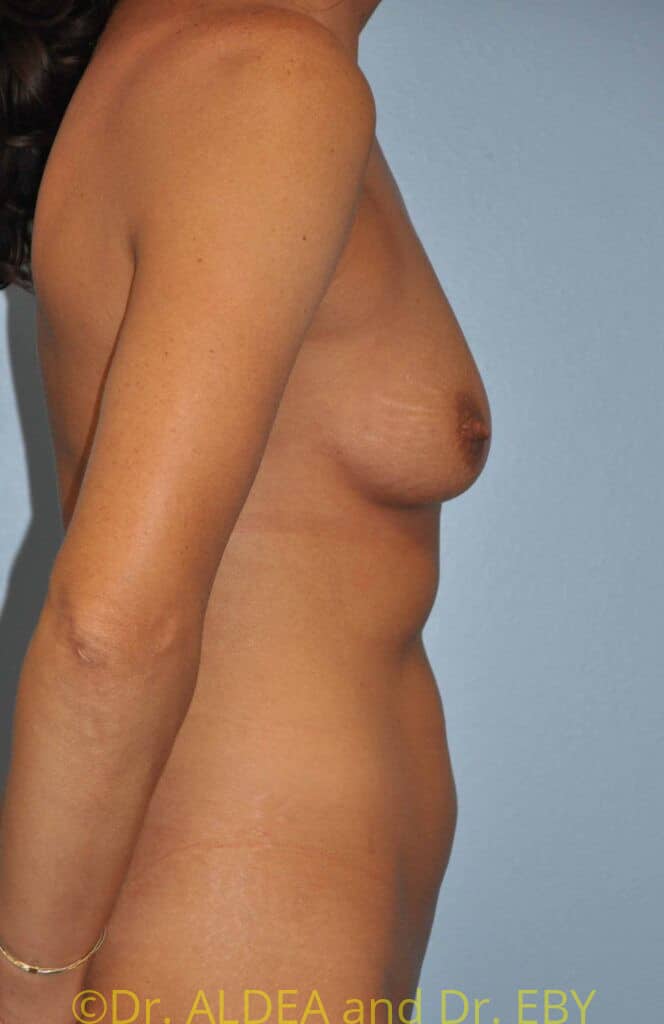 Before Image: Breast Augmentation w/ Lift #210 - right-side