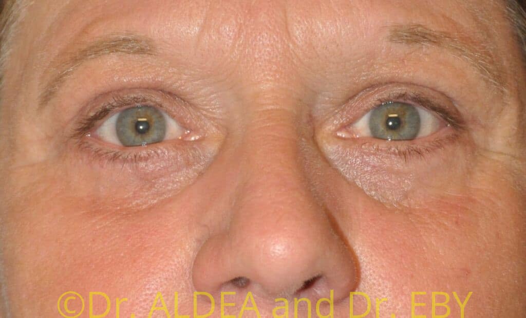 After Image: Blepharoplasty #944 - front