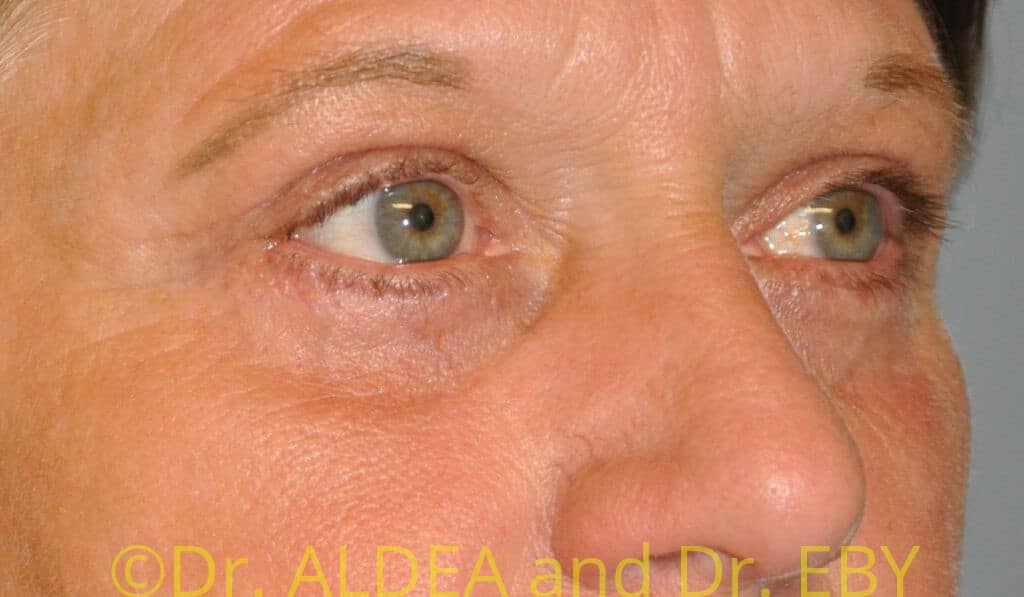 After Image: Blepharoplasty #944 - right-front-oblique