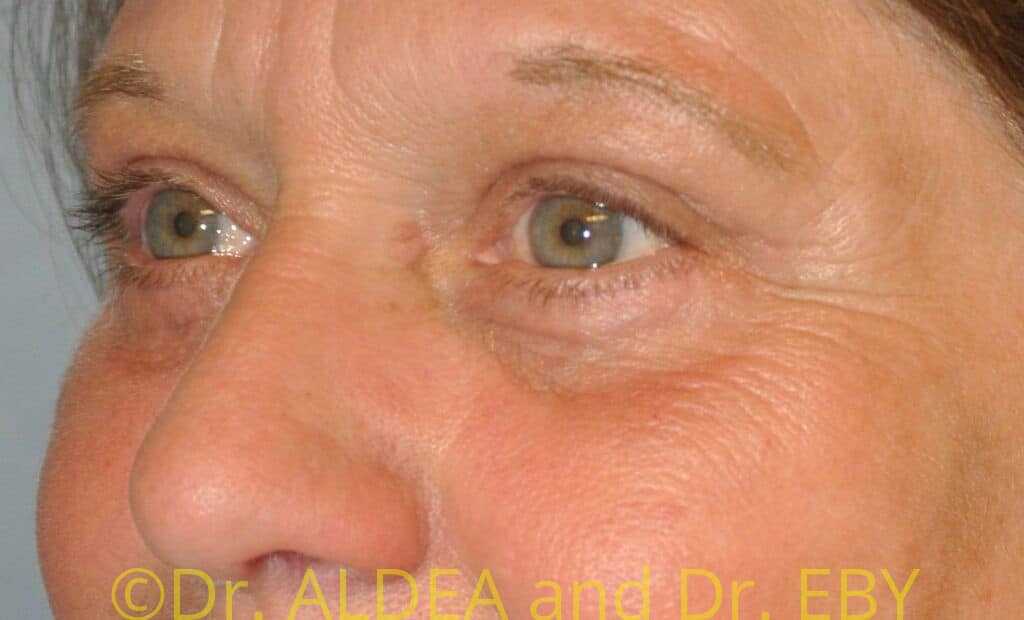 After Image: Blepharoplasty #944 - left-front-oblique