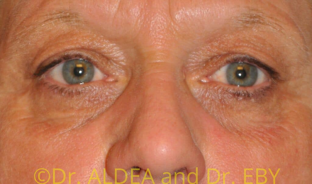 Before Image: Blepharoplasty #944 - front