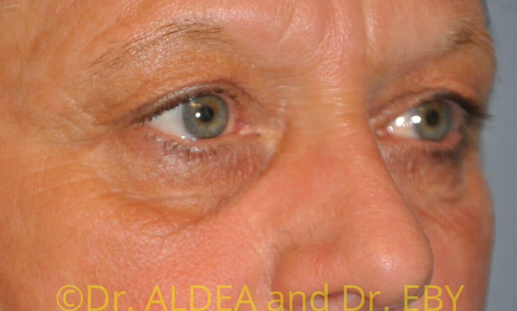 Before Image: Blepharoplasty #944 - right-front-oblique