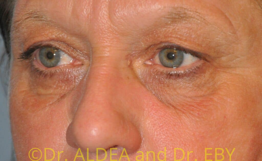 Before Image: Blepharoplasty #944 - left-front-oblique
